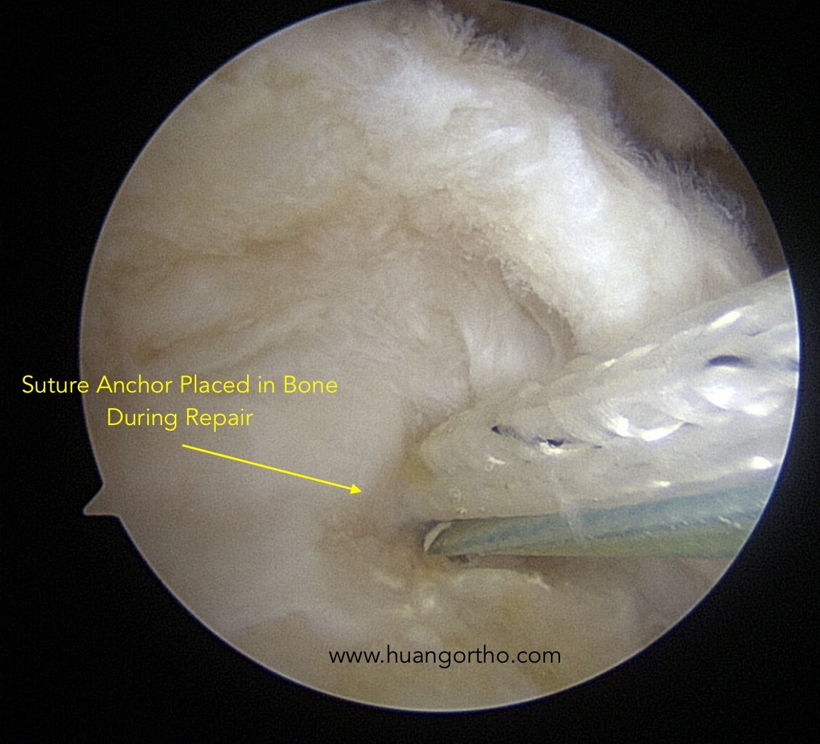 Rotator Cuff Repair