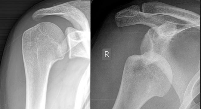 Dislocated Shoulder X-ray (right) compared to normal shoulder X-ray (left)