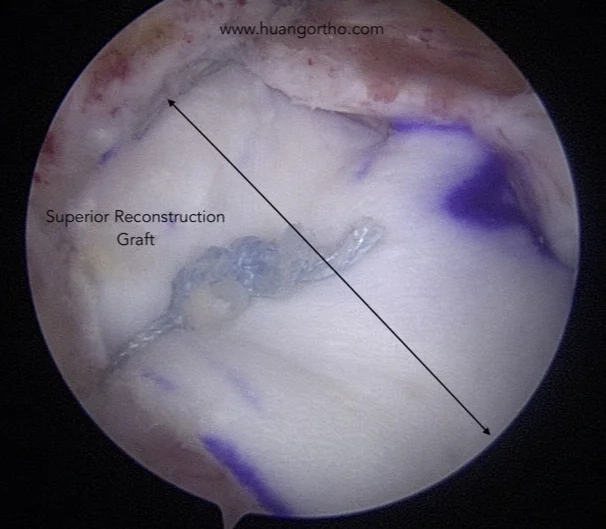 Superior Capsular Reconstruction Graft in place. It has been contacted to patient's glenoid and humeral head and remaining rotator cuff tendon.