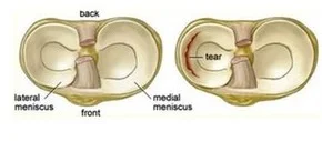 Looking top down on the meniscus of the knee. They are "C" shaped structures thicker on the periphery.