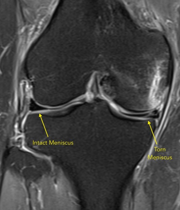 medial meniscus tear