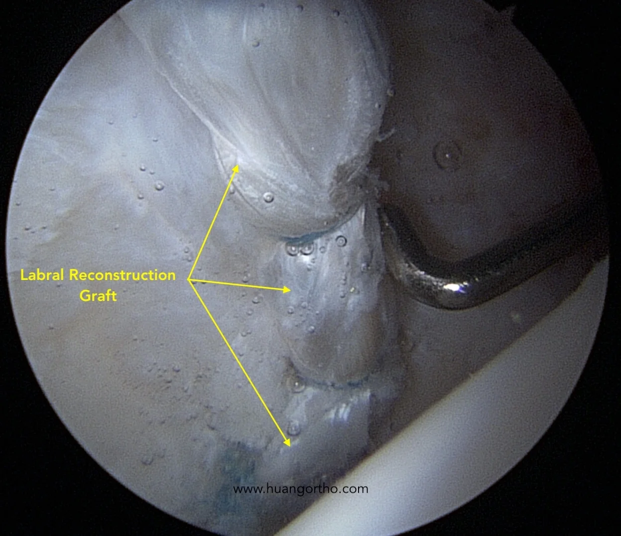 Hip labral reconstruction with graft attached to acetabulum