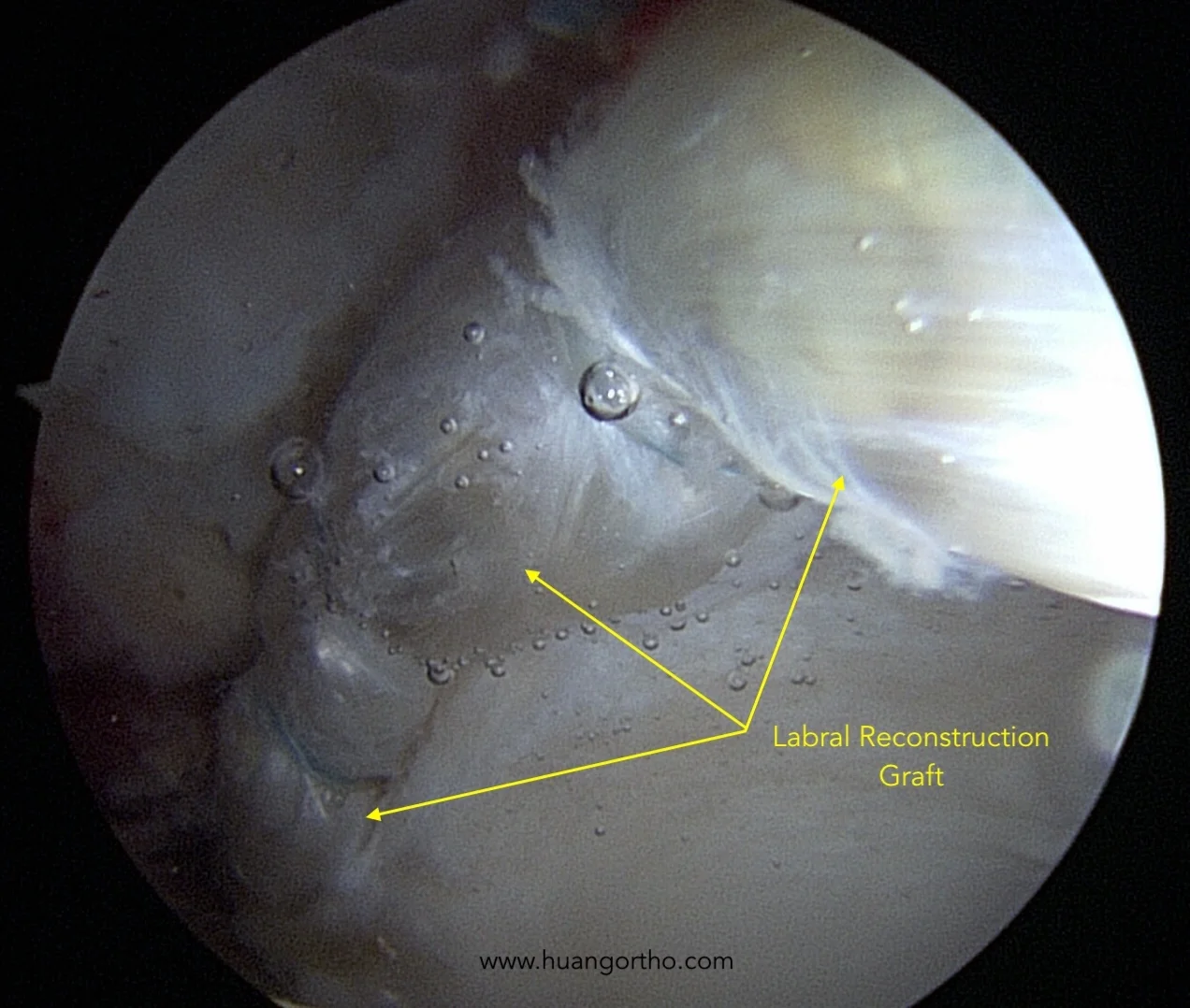 Hip labral reconstruction with graft attached to acetabulum