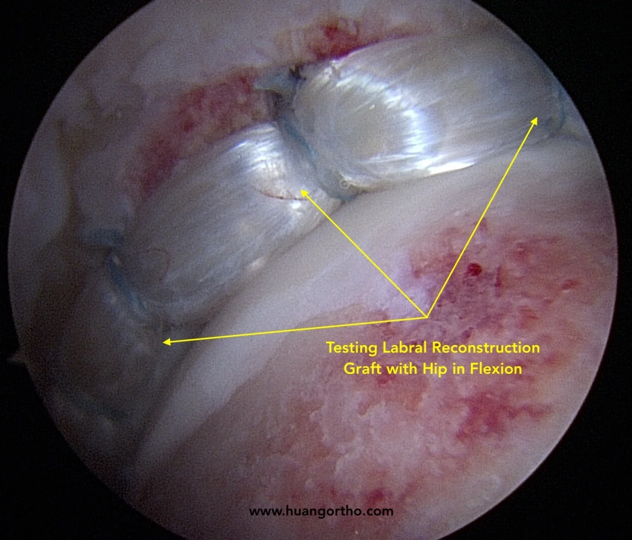 Hip labral reconstruction graft with traction off demonstrating restoration of hip joint seal in hip flexion