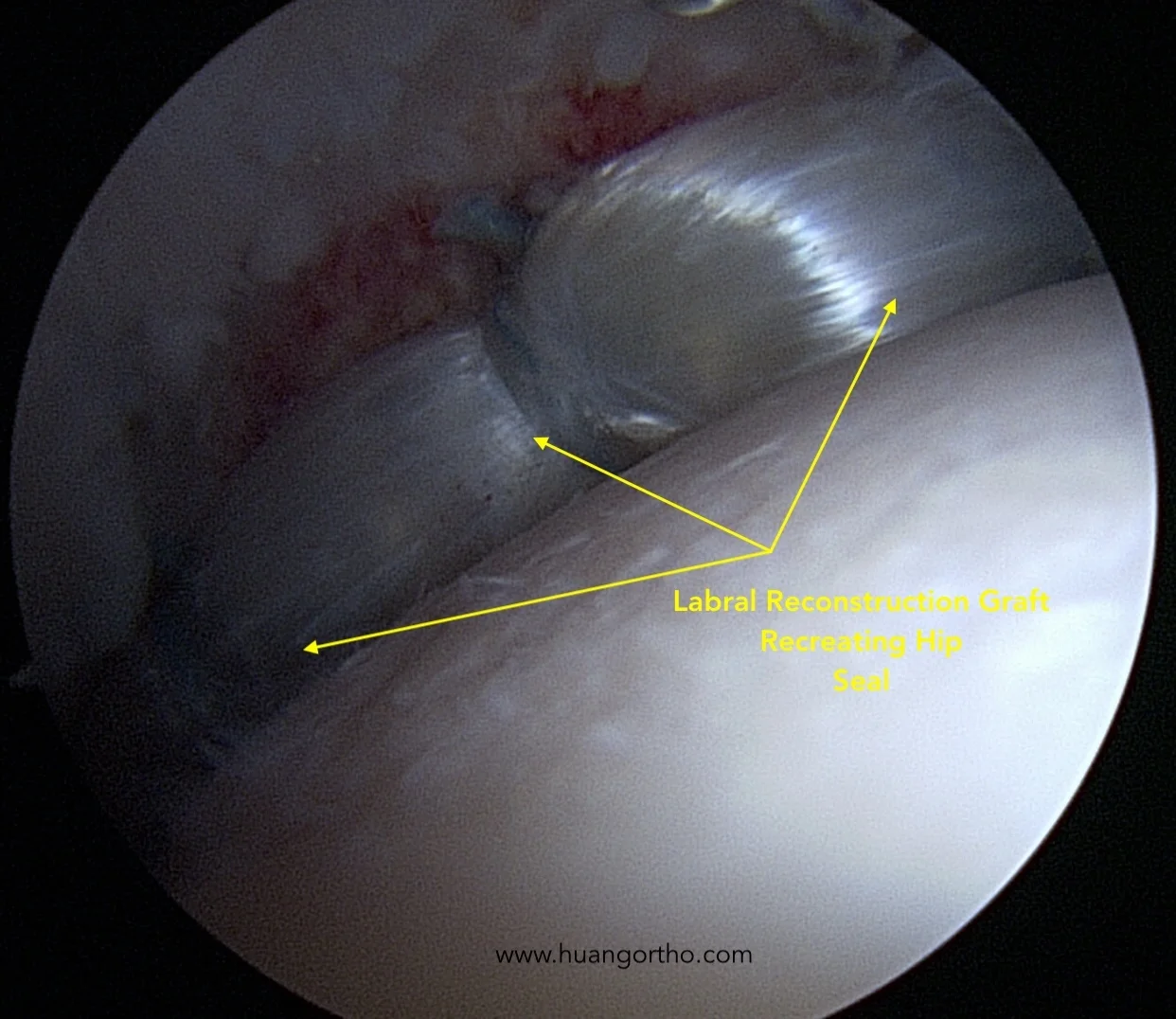 Hip labral reconstruction graft with traction off demonstrating restoration of hip joint seal