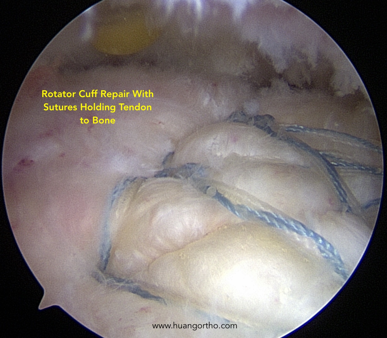 Rotator Cuff Repair 4.jpg