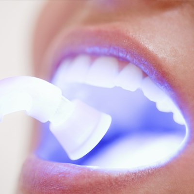 composite filling smiles tyle dental.png