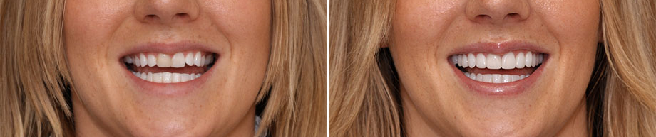 porcelain veneers before and after.png