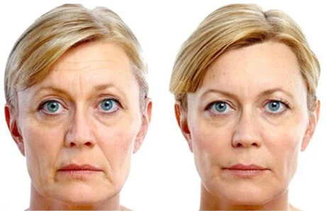 Dermal fillers Smile style.jpg