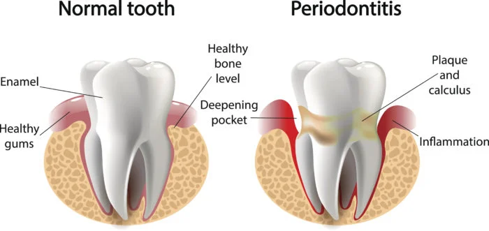 periodontal disease smile style.jpg