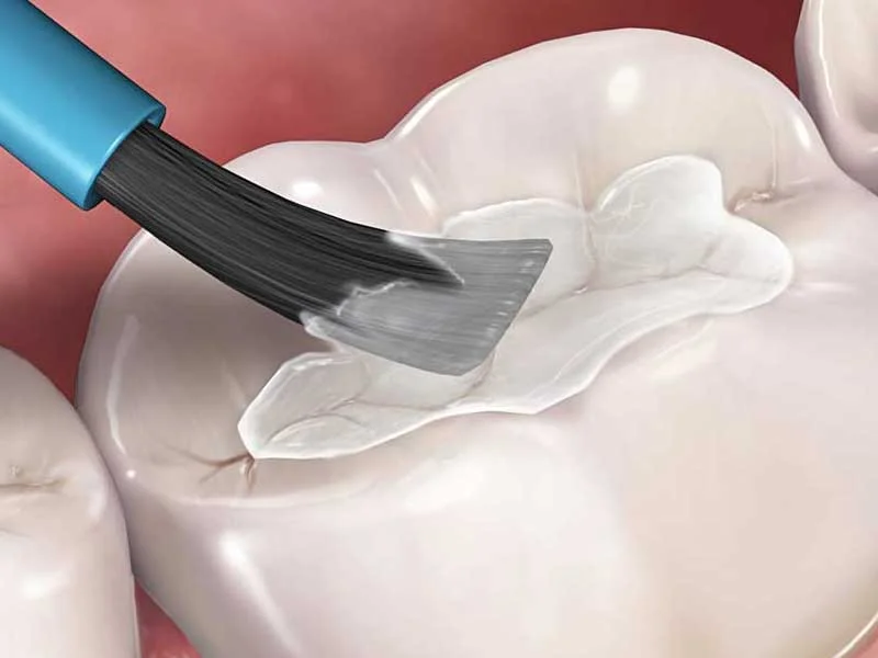 fissure sealant.jpg