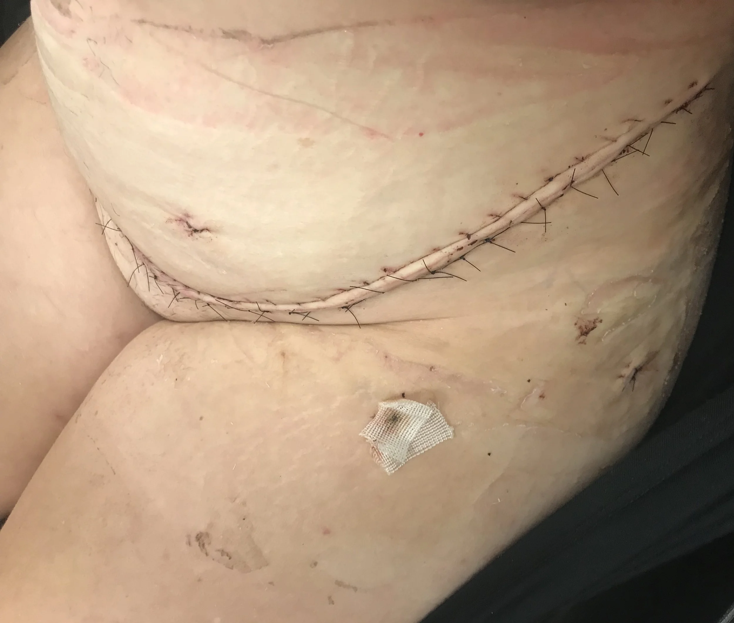 The 14" scar that goes from one hip to the other and includes three holes in my leg where the blood &amp; fluids were draining out of me.