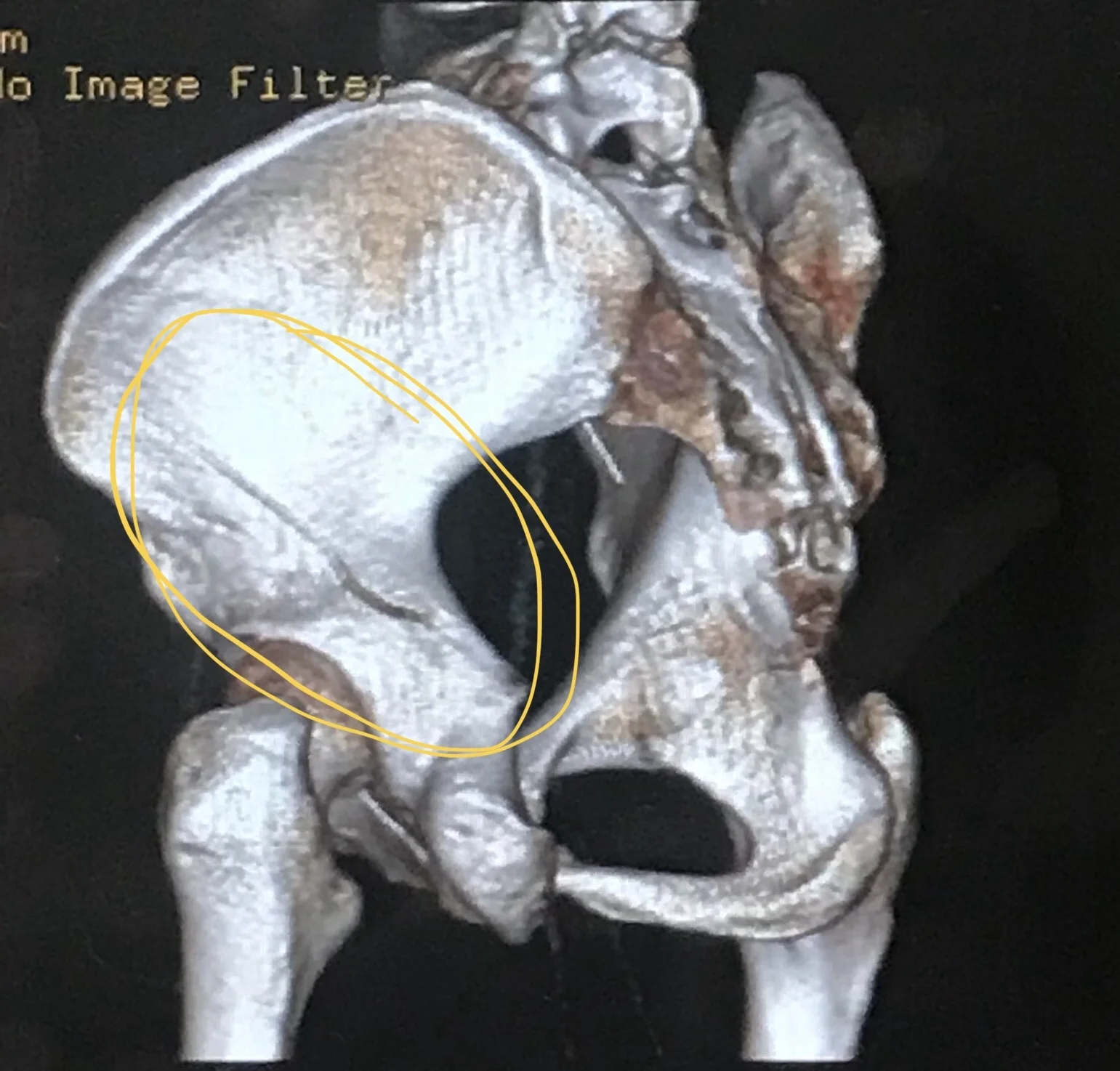 The biggest of several fractures.