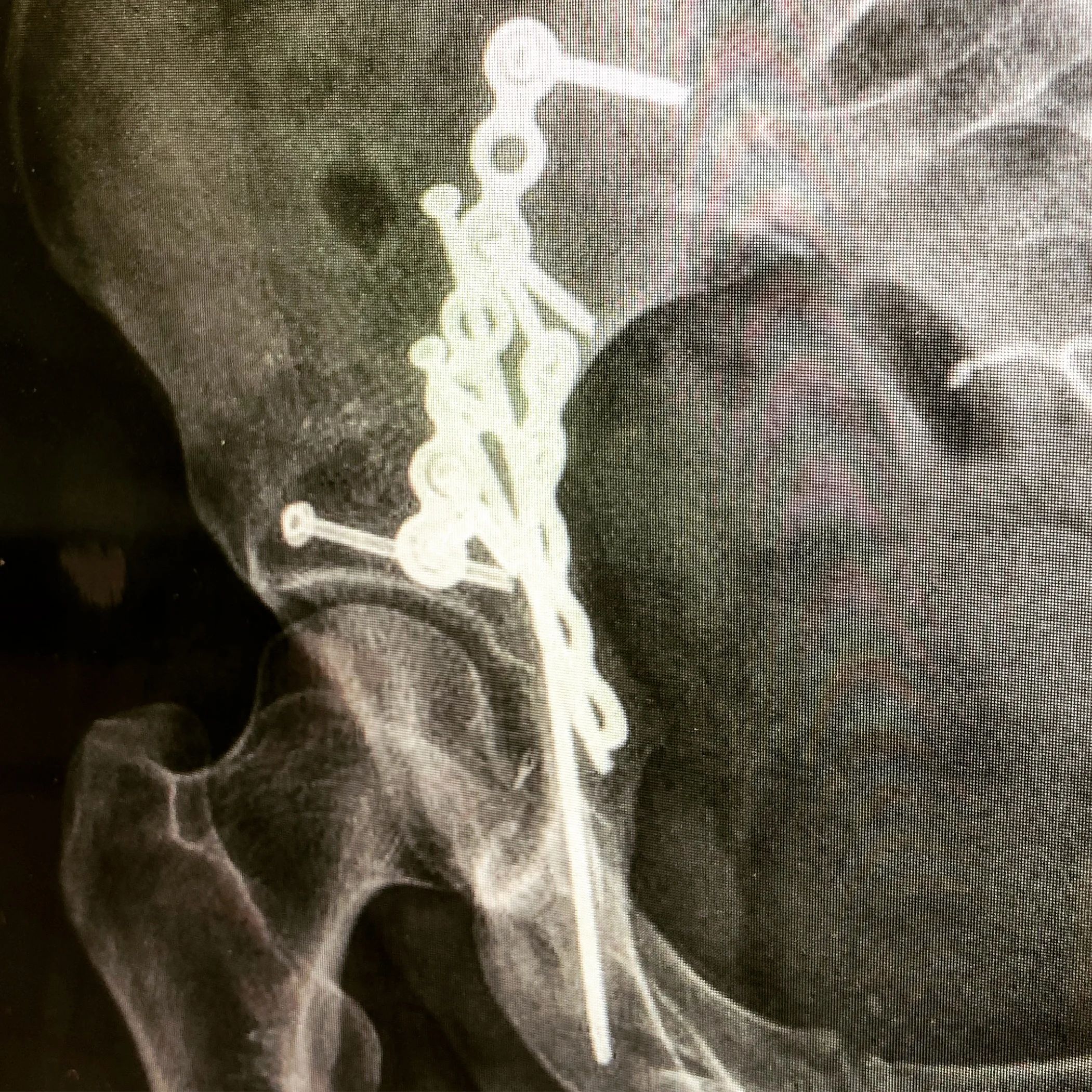 Updated X-Rays. Still holding strong.