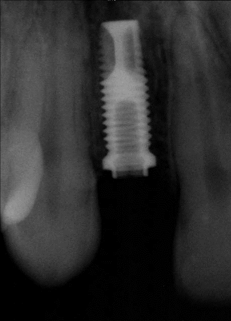Radiograph after implant placed