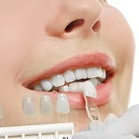 DENTAL VENEERS AND DENTAL LAMINATES