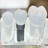 SMILE MAKEOVER