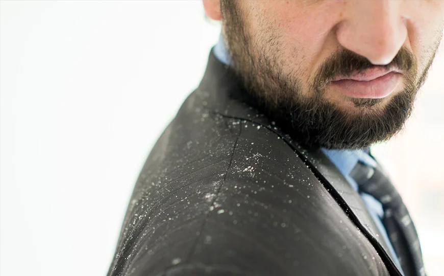 dandruff.jpg