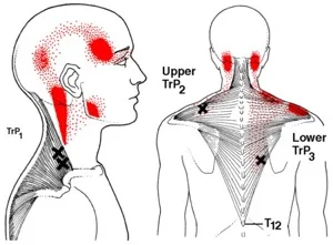 trigger-point-1.jpg