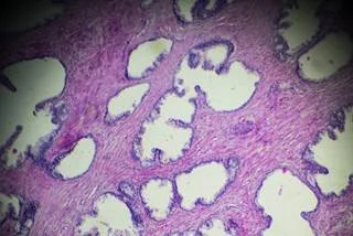 gettyimagesprostatebiopsyti_1371394.jpg