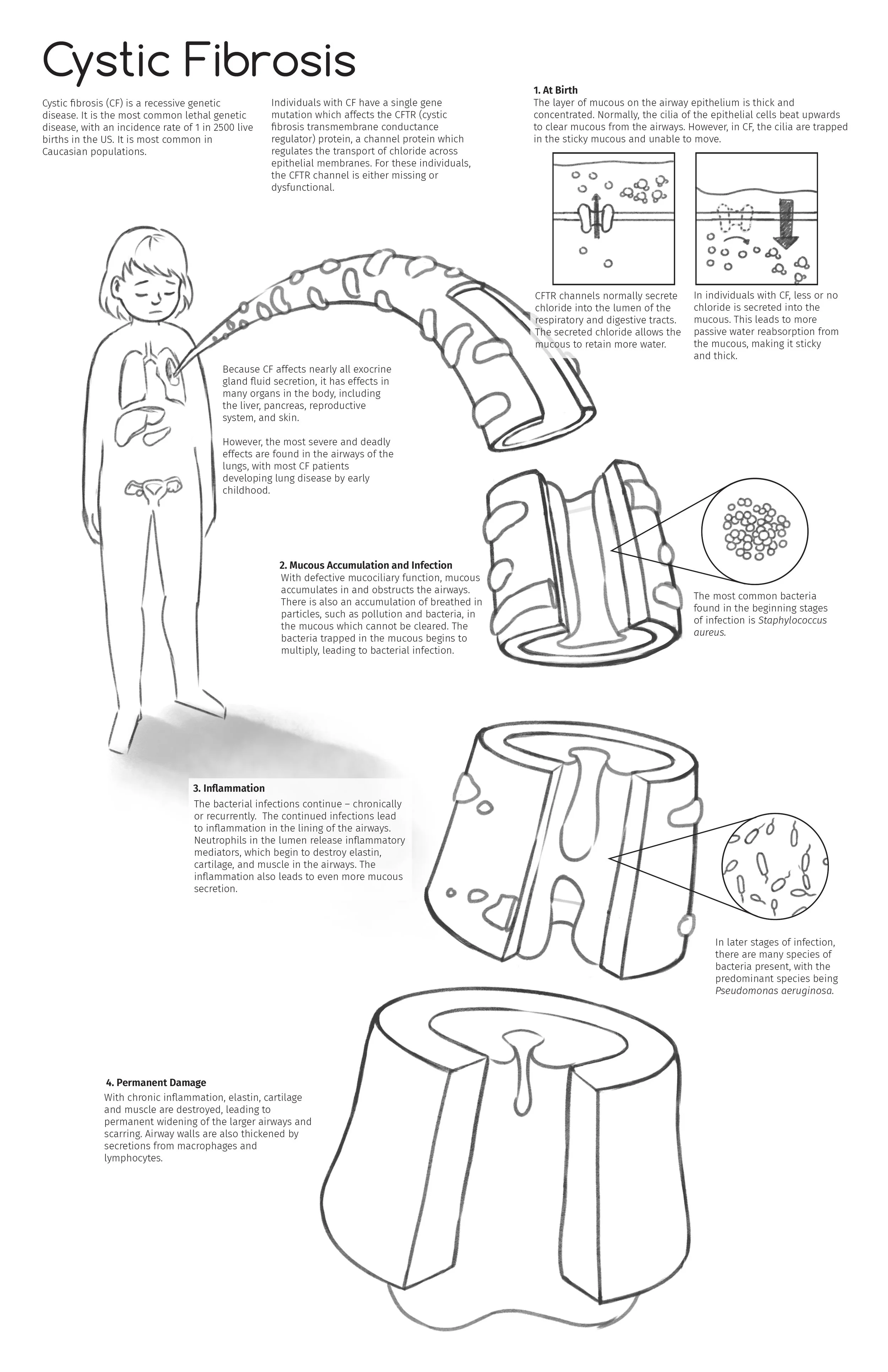 Cystic Fibrosis Layout1-01.jpg