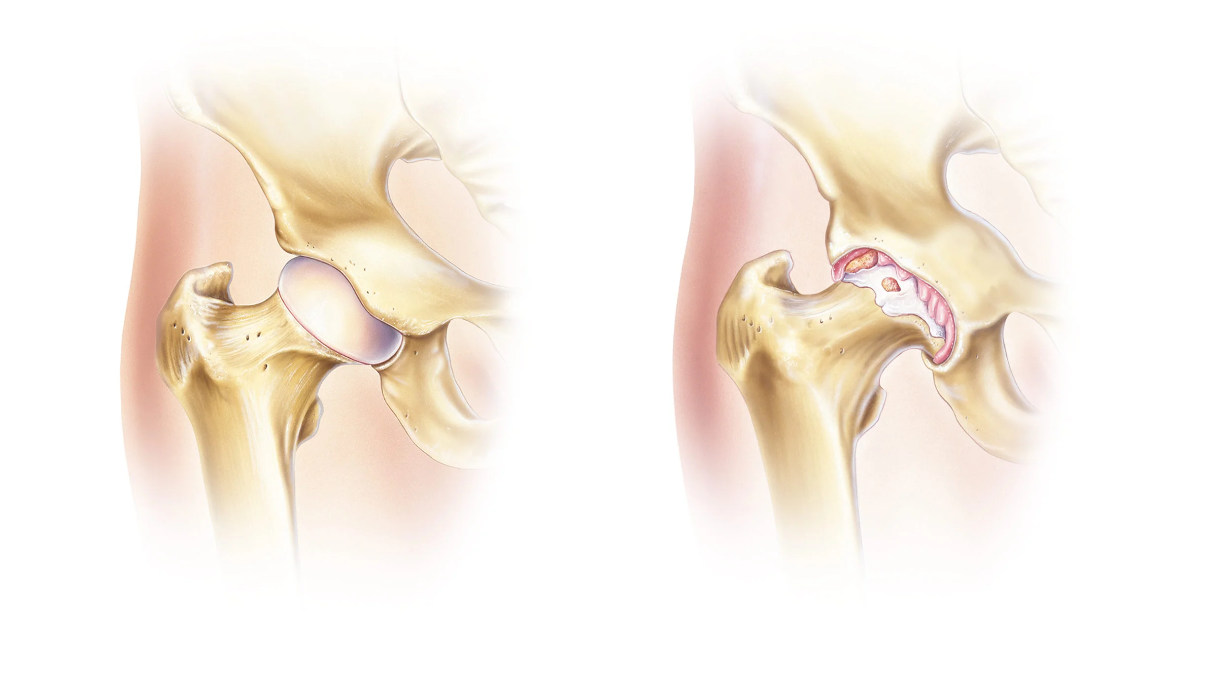 Left: Healthy Hip Joint.&nbsp; Right: Hip Joint affected by Osteoarthritis.
