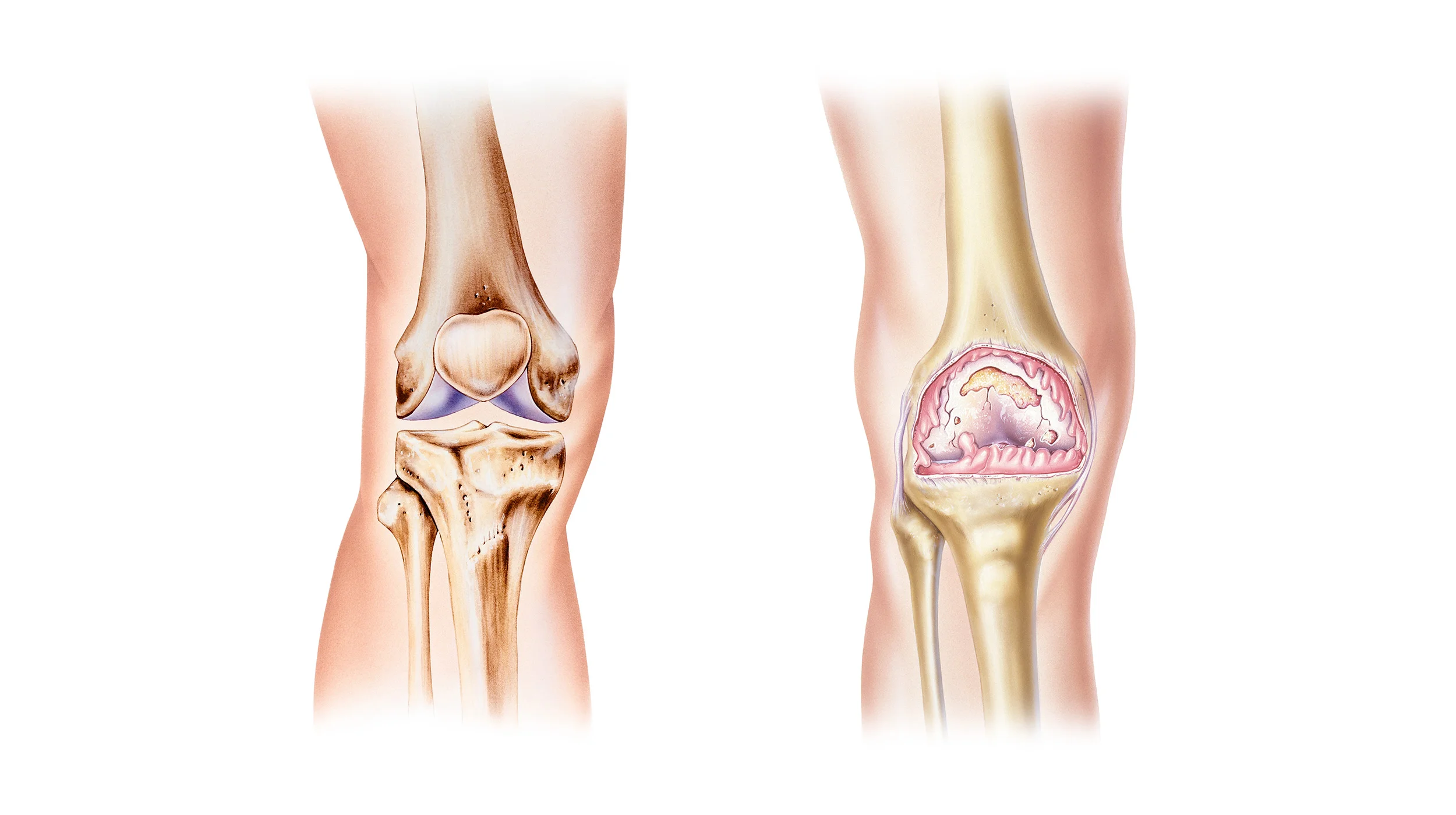 Left: Healthy Knee Joint.&nbsp; Right: Knee Joint affected by Osteoarthritis.