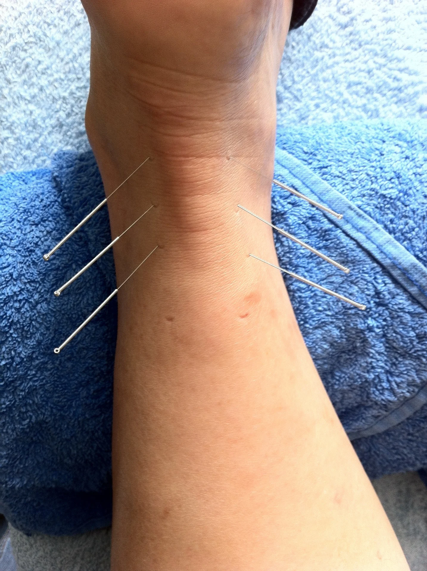 acu needles in ankle.jpg