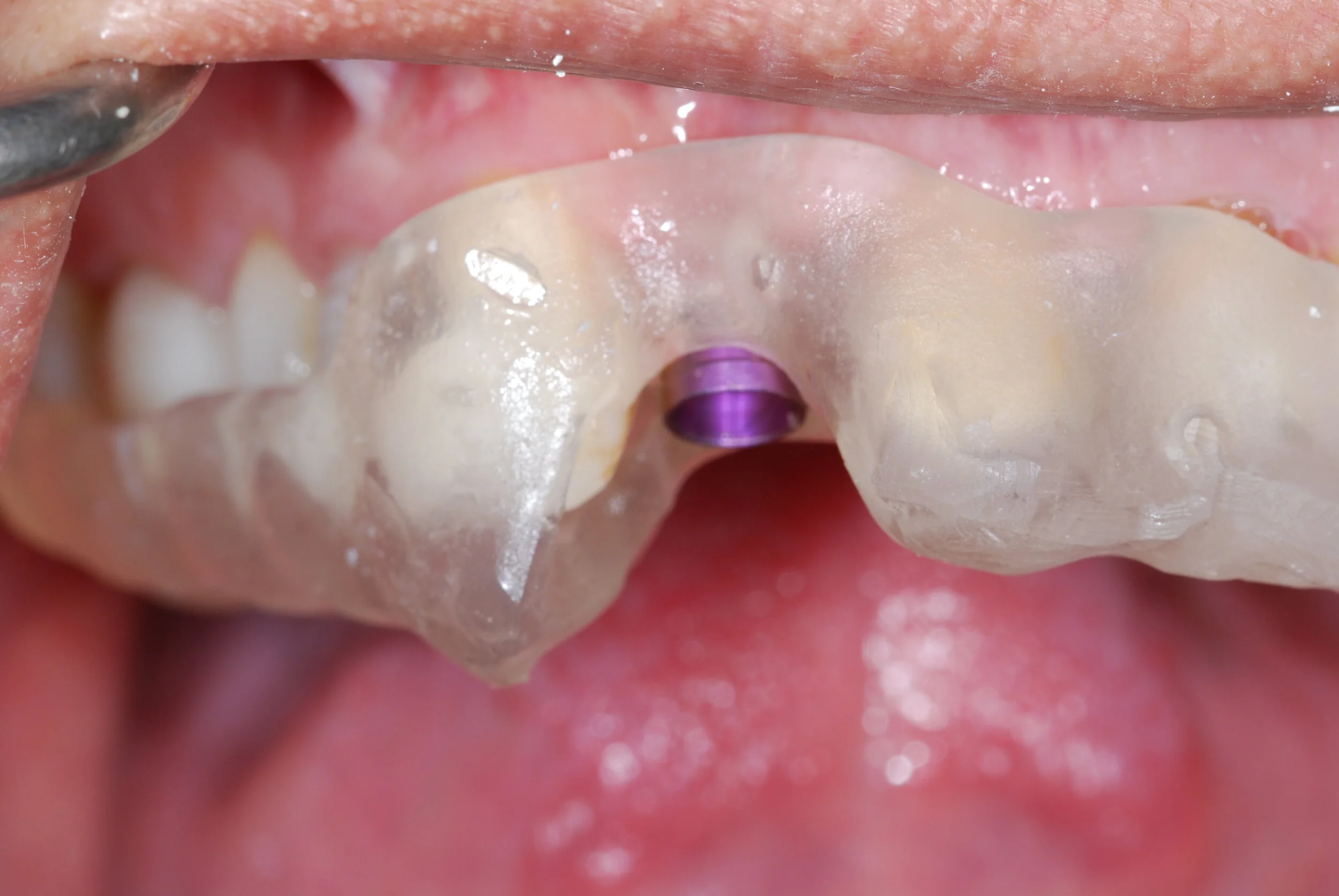 CIRURGIA DE IMPLANTES GUIADA