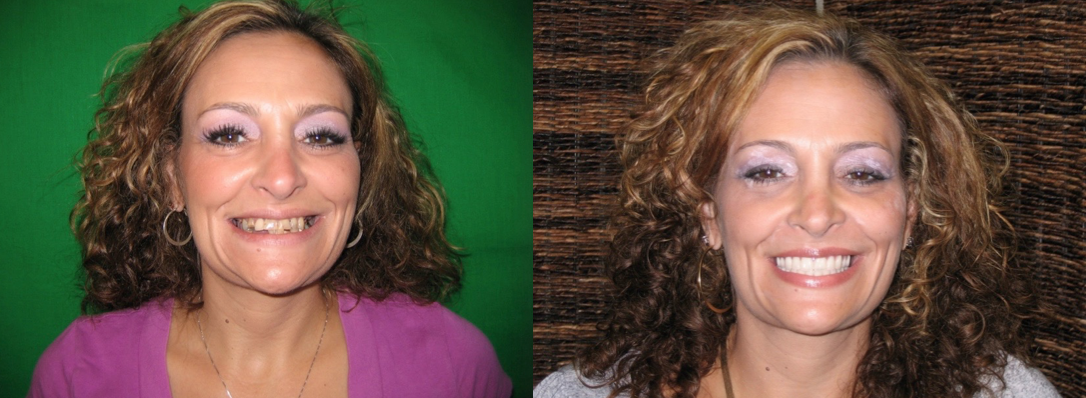 Before and after photos of a patient who received same day provisional upper and lower implant supported fixed bridges.The after photo was taken 3 weeks after the surgery.
