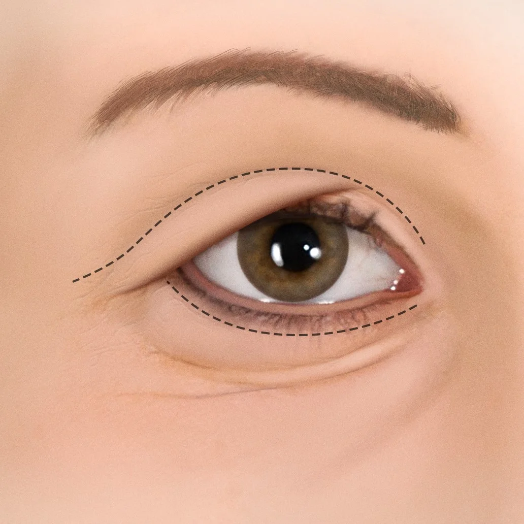 Blepharoplasty.jpg