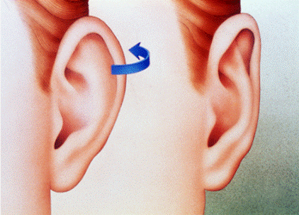 earreshaping_clip_image002.gif