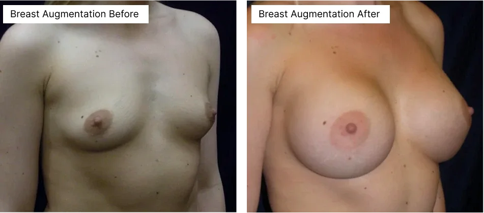 breast-augmentation-rick-becker.webp