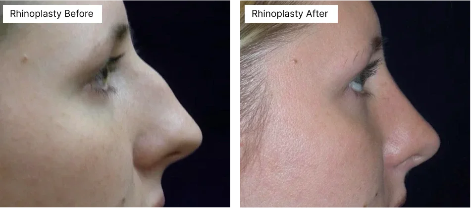 rhinoplasty-rick-becker.webp