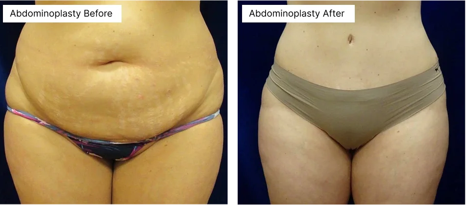 abdominoplasty-rick-becker.webp