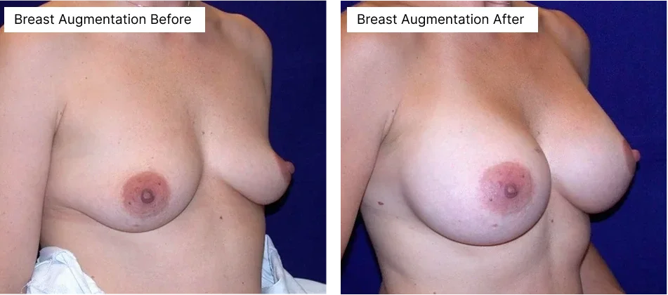 breast-augmentation-rick-becker-plastic-surgery.webp