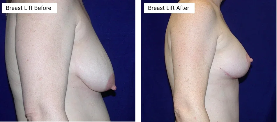 breast-lift-rick-becker.webp