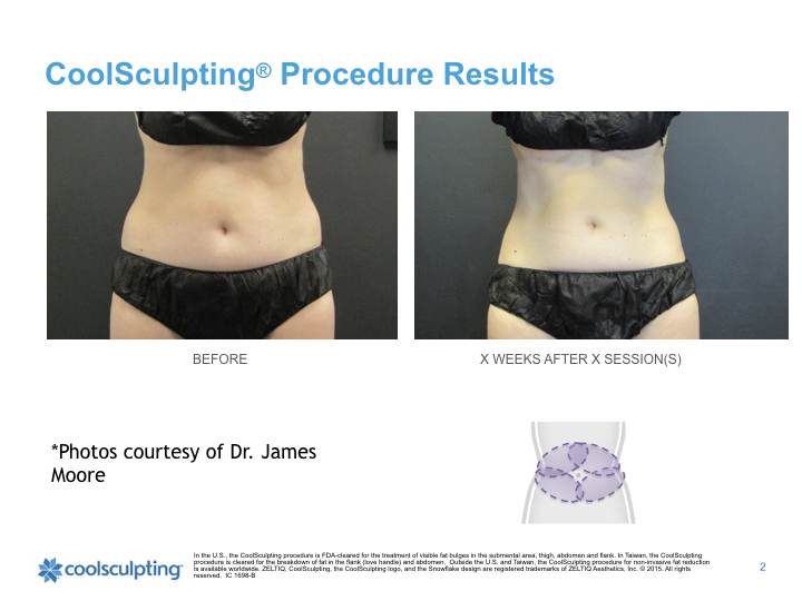 Coolsculpting — The Moore Center Medical Spa