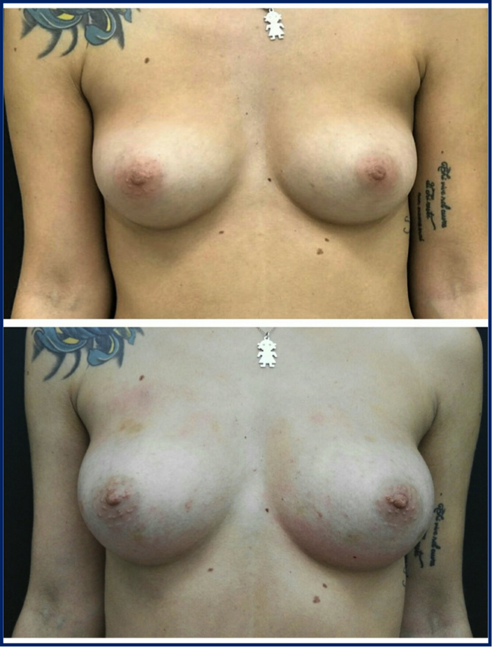 breast befaft2.png