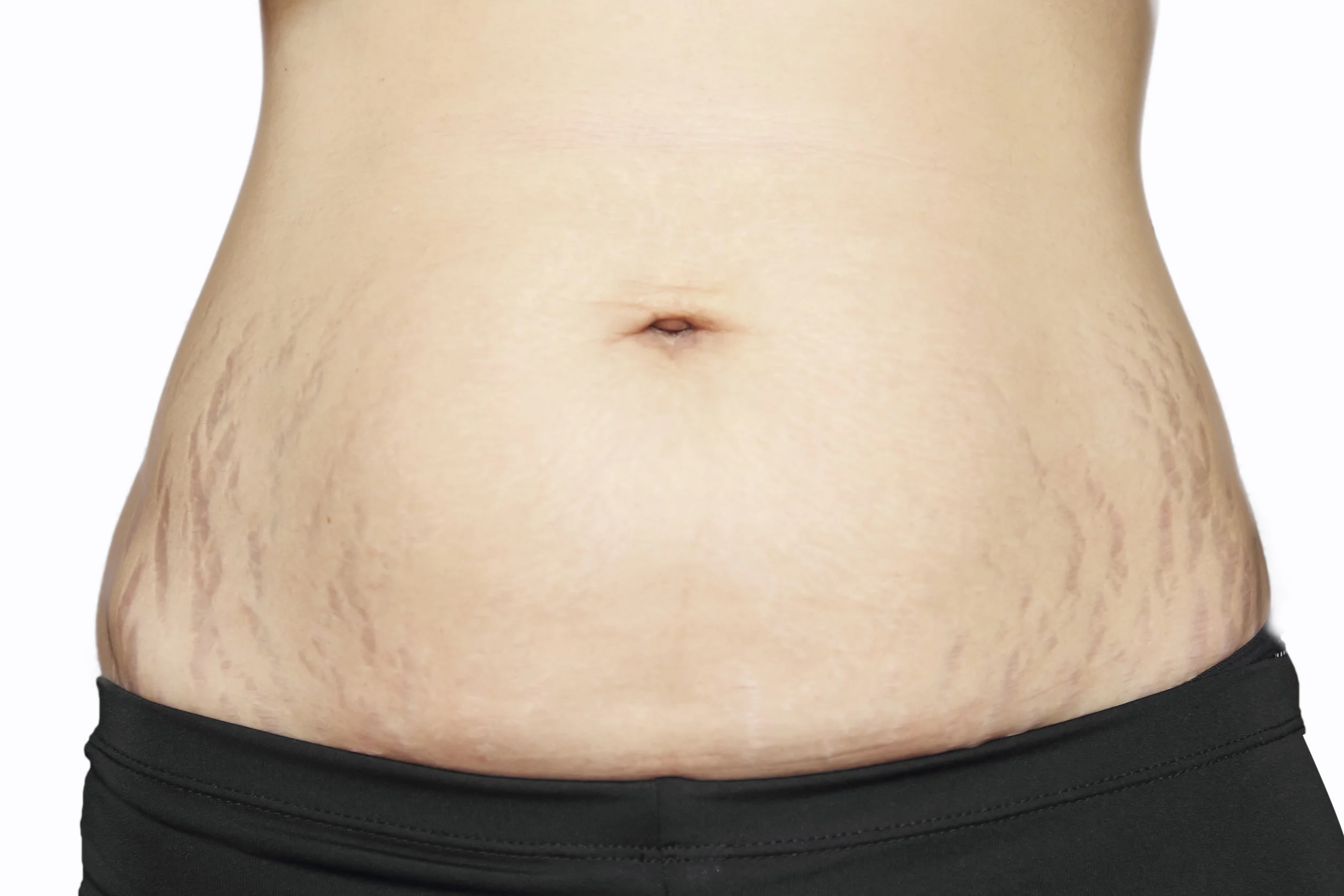Stretch Marks Treatments Bellezza Clinic London