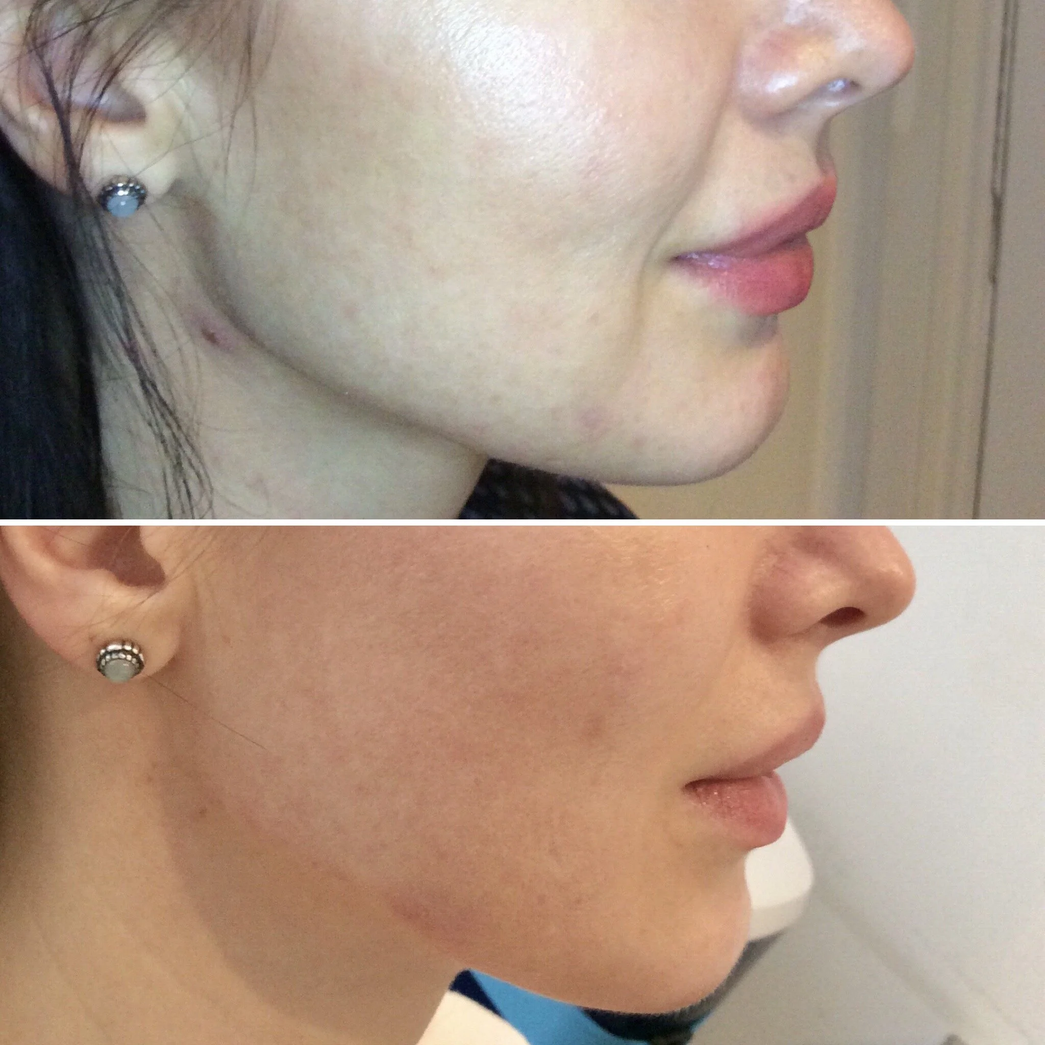 Profhilo Before and After Pictures