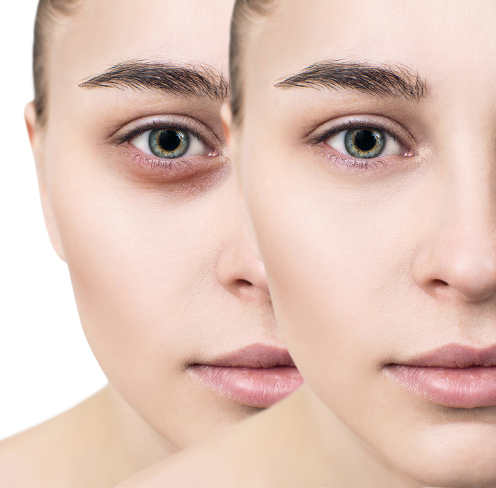 dermapen for dark circles