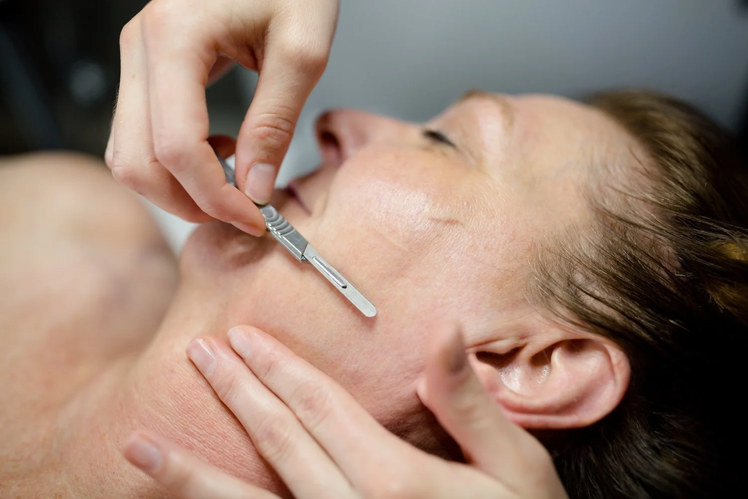 Dermaplaning