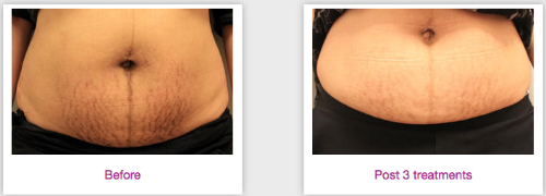 sublativebodycontouring.png