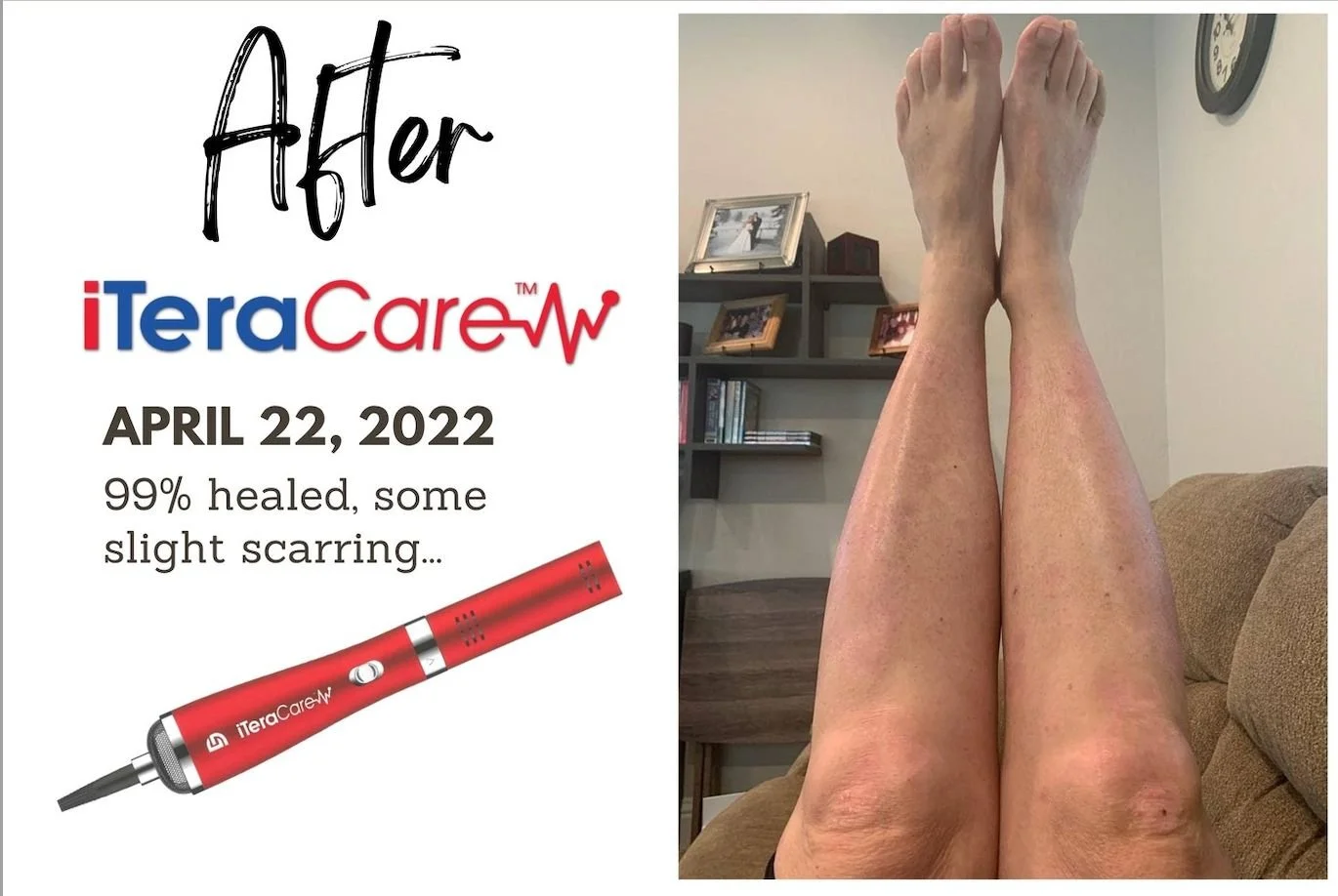 iteracare-testimonial-psoriasis-after.jpg