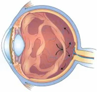 Diagram of fluid shift in the eye and detachment of the Vitreous.