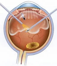 Vitrectomy instruments in the eye
