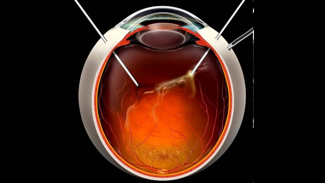 Vitrectomy