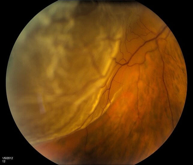 Detached Retina