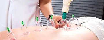 cupping.jpeg